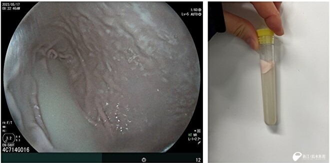 内視鏡画像からも白濁した胃液を確認（写真左）／「ミライ」の遠心分離後の胃液（写真右）