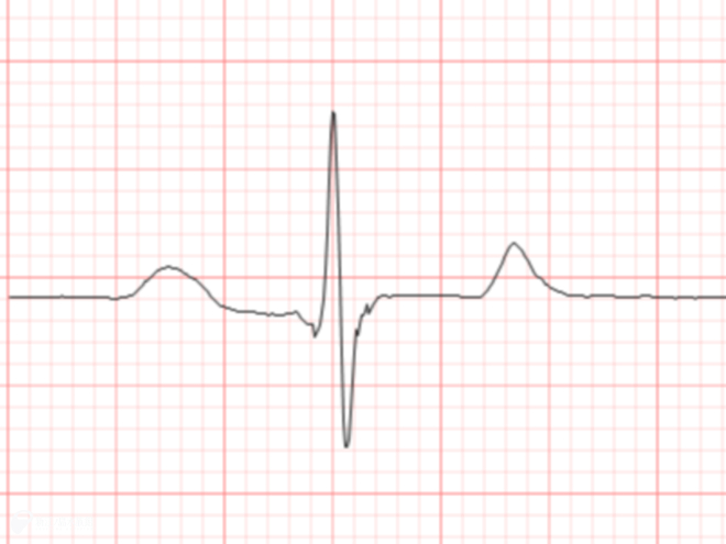 ライラの心電図波形の一部