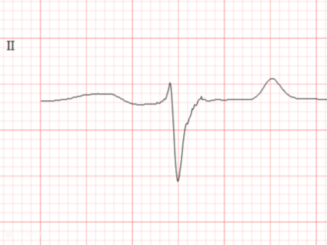 バンドウイルカ「サワ」の心電図波形
